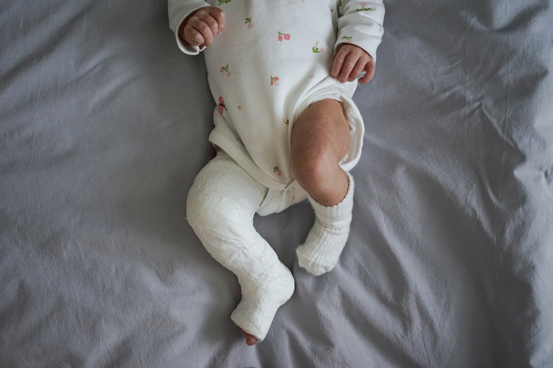 Top view newborn little baby with leg in a cast - clubfoot.